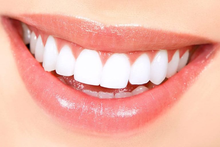 What Daily Habits Compromise Veneers and How to Protect Your Investment